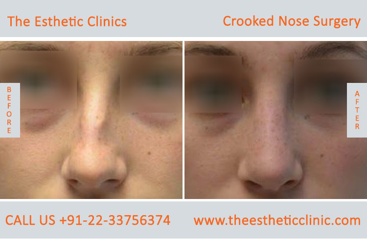 Crooked Nose Surgery before after photos in mumbai india (3)